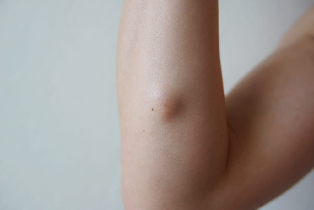 Clinica Dermatológica Reviva - Remoção de Cisto Sebáceo