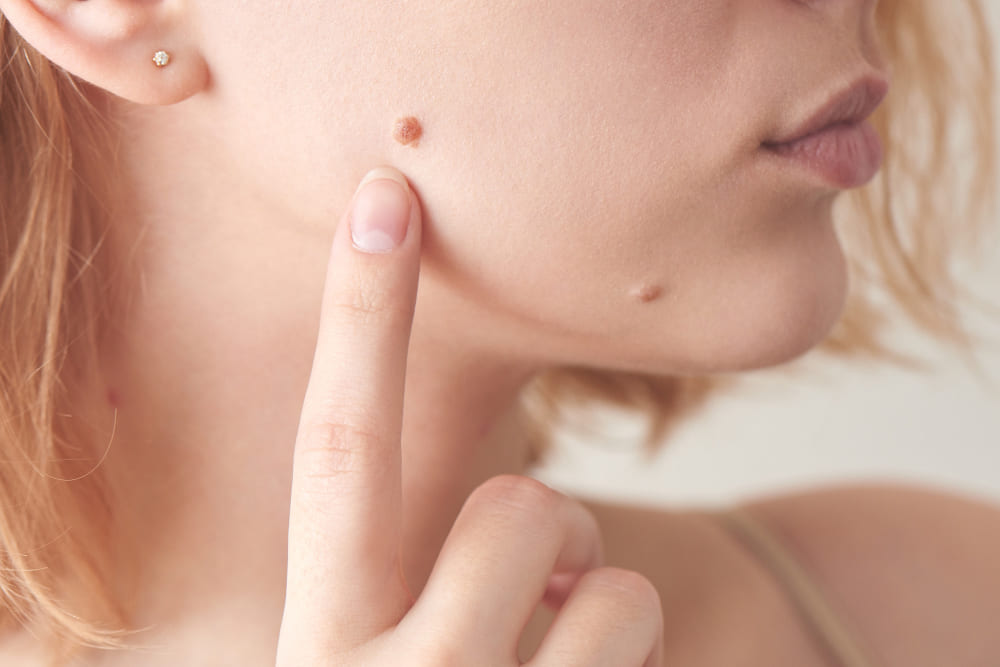 Remoção de Pinta - Clínica Dermatológica Reviva, Cambuí Campinas