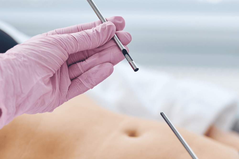 Serviço Clinica Dermatológica Reviva: Exame de biópsia para identificar doenças de pele e manchas suspeitas com precisão.