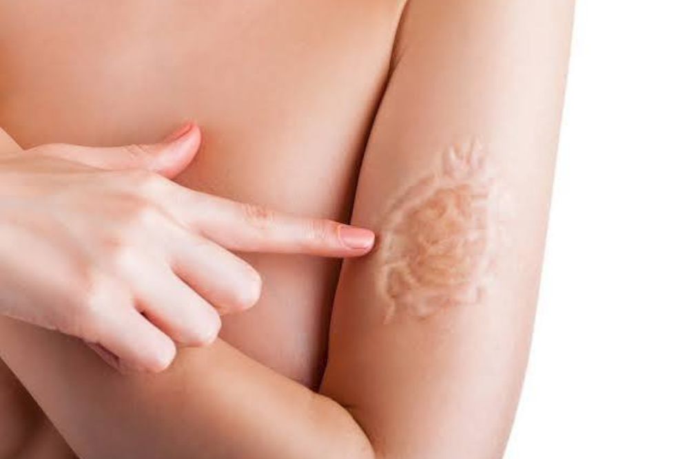Clinica Dermatológica Reviva : Reconstrução da Pele (Enxertos e Retalhos)