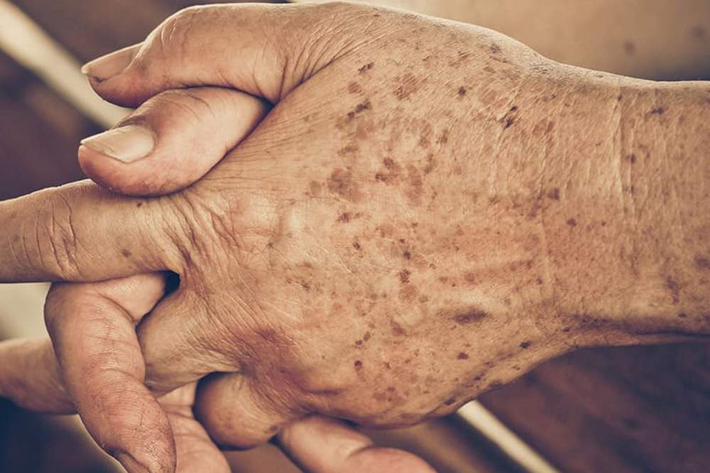 Clinica Dermatológica Reviva : Remoção de manchas senis nas mãos