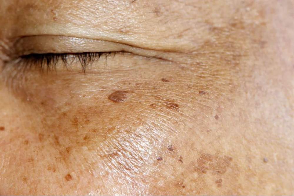 Clinica Dermatológica Reviva : Remoção de manchas solares no rosto