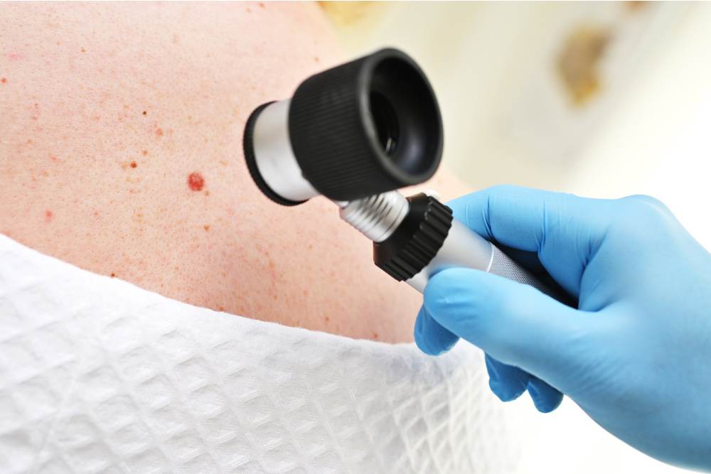 Clínica Dermatológica Reviva: Dermatoscopia - mapeamento de pintas