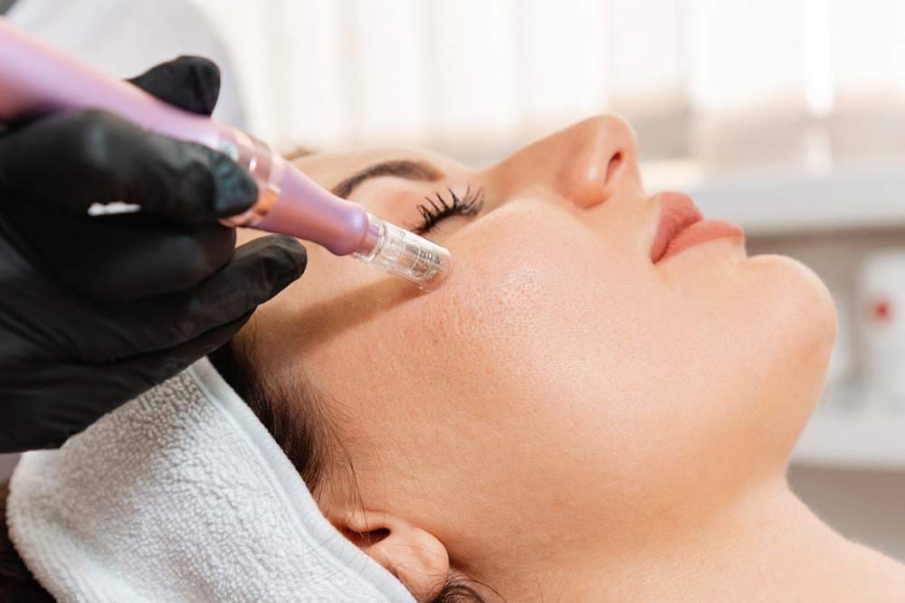 Clínica Dermatológica Reviva: Microagulhamento