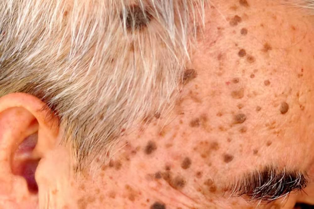 Clinica Dermatológica Reviva : Remoção de manchas senis
