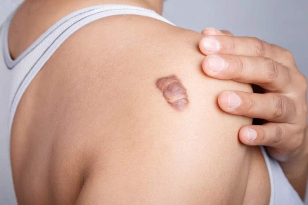 Clinica Dermatológica Reviva : Tratamento de cicatrizes e queloide