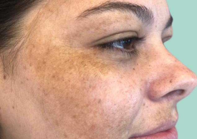 Resultado Antes tratamento a Laser para tirar manchas