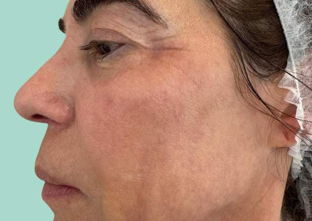 Resultado Depois tratamento a Laser para tirar manchas